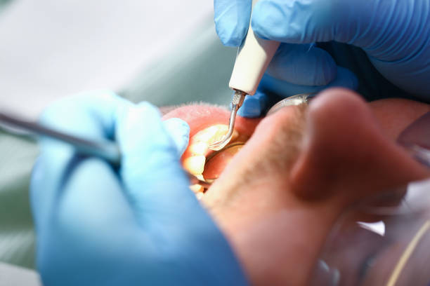 Best Emergency Root Canal Treatment in Amherst, VA
