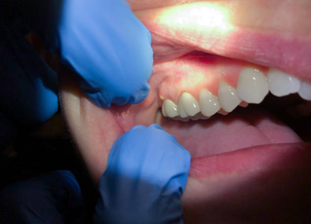Best Emergency Tooth Extraction in Amherst, VA